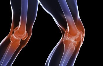 Damaged knee joints requiring total knee replacement surgery.