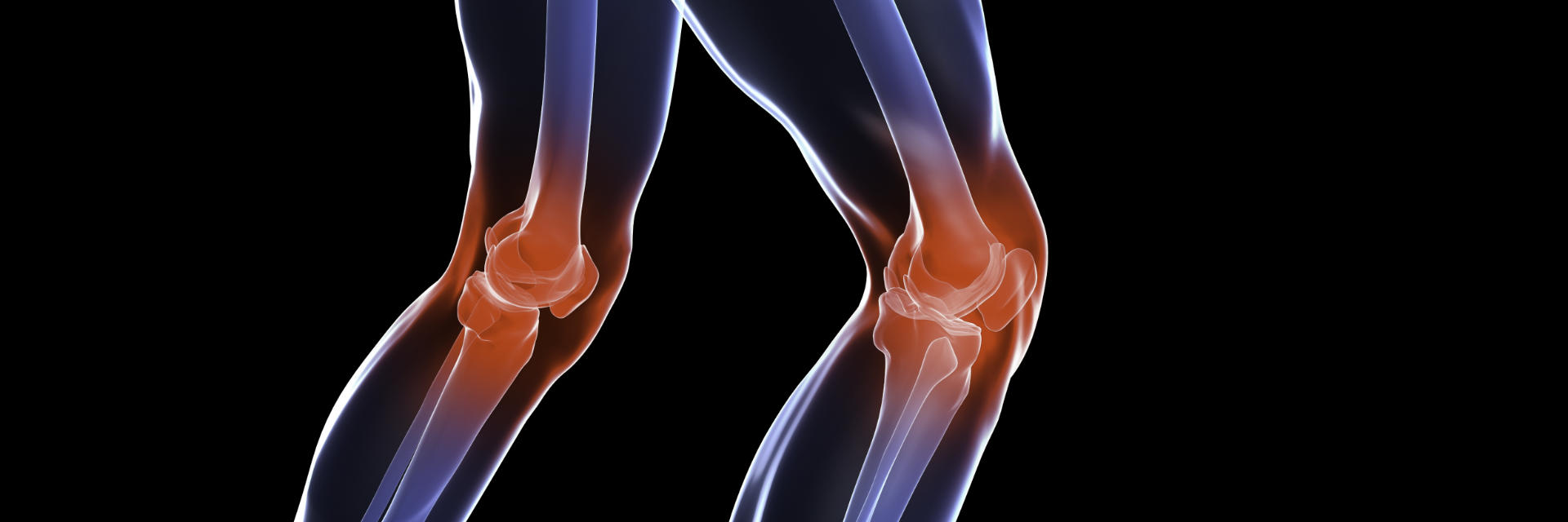 Damaged knee joints requiring total knee replacement surgery.