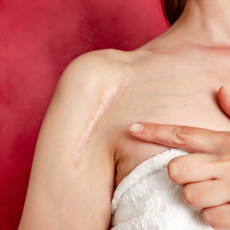 Postoperative scar on a woman's shoulder. A woman shows the scar. Scar after surgery after a broken arm bone.