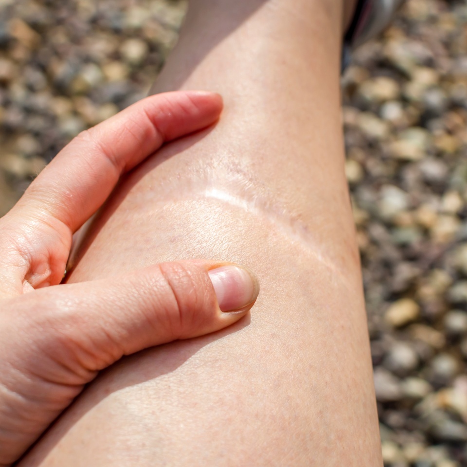 Close-up of a healed scar on a leg. Postoperative scars
